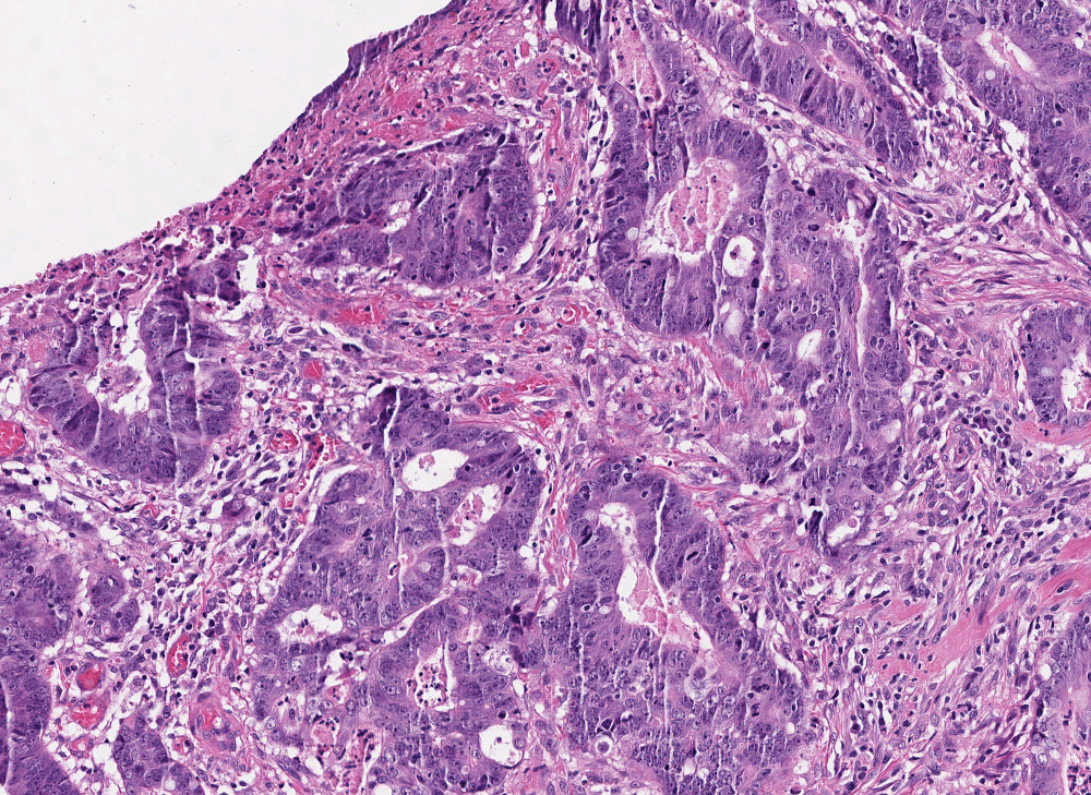 Regional Lymph Node Metastasis In Colon Adenocarcinoma Doi Aida Lnco Aida Dataset