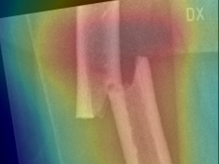 Figure 1. Femur fracture radiograph with an AI generated heatmap indicating probable presence and location of an Atypical Femur Fracture.