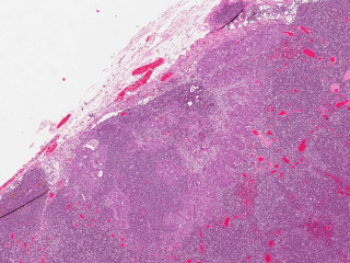 Figure 3. Detail view of metastasis with hematoxylin and eosin staining.