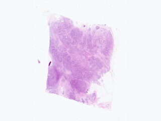 Figure 3. Example from case 11 in this dataset, here showing the chosen image from the surgical sample (excision) in low resolution, that is paired on case level with an image of the preoperative biopsy from the same breastcancer