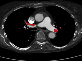 Figure 3. Axial CTPA image with annotated pulmonary emboli.