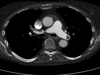 Figure 2. Axial CTPA image showing pulmonary emboli.