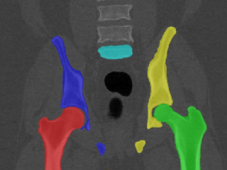 Figure 2. Segmentation masks for femur, pelvis, and vertebra shown in a frontal plane CT image.