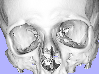 Figure 1. 3D visualisation of typical coverage that goes down to the maxilla and covers the entire skull and including the mastoids.