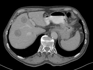 Figure 2. Slice from thorax CT stack with annotated liver metastases.