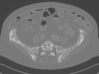 Figure 2. Slice from thorax CT stack with annotated sclerotic and lytic bone metastases.