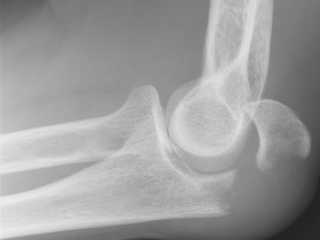 Figure 1. Lateral view of an olecranon fracture (2U1B1).