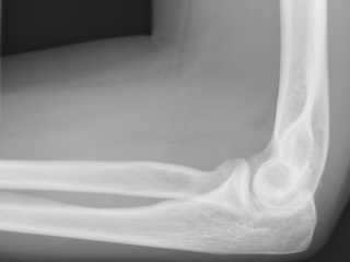 Figure 2. Lateral view of a proximal radius fracture (2R1A).