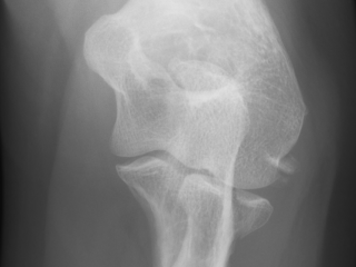 Figure 3. Frontal view of a proximal radius fracture (2R1B1).