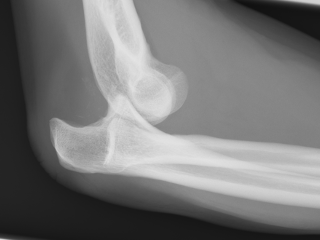 Figure 4. Lateral view of a dislocated elbow joint.