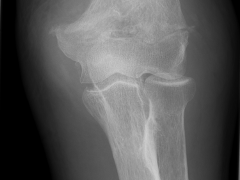 Figure 5. Frontal view of a transverse distal humerus fracture (13A2.3).