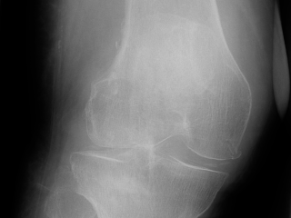Figure 1. Frontal knee radiograph.