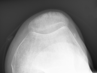 Figure 3. Lateral view with TKA.