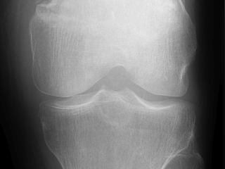 Figure 1. Frontal knee.