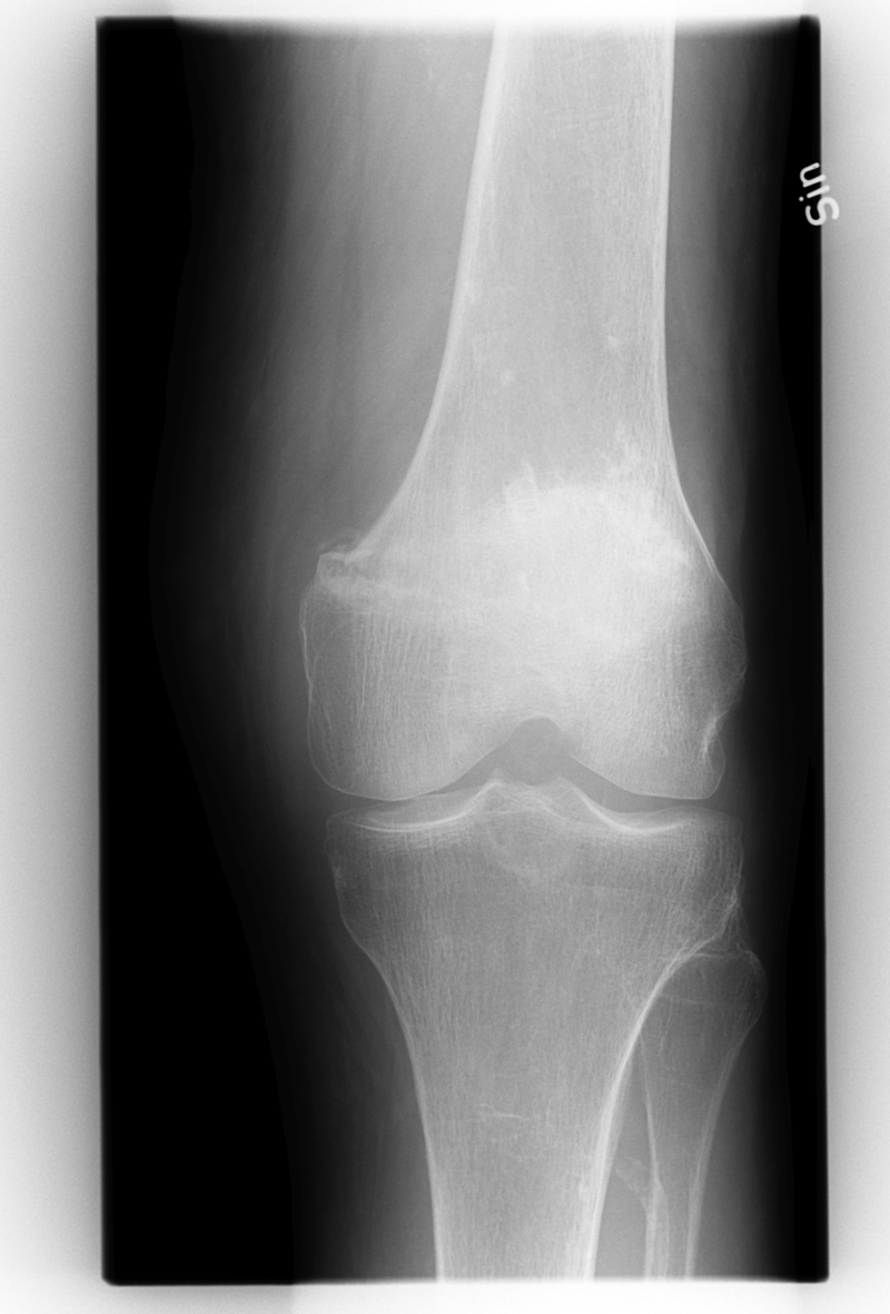 Knee osteoarthritis classification according to Kellgren-Lawrence | doi ...