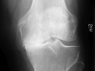 Figure 3. Frontal knee.
