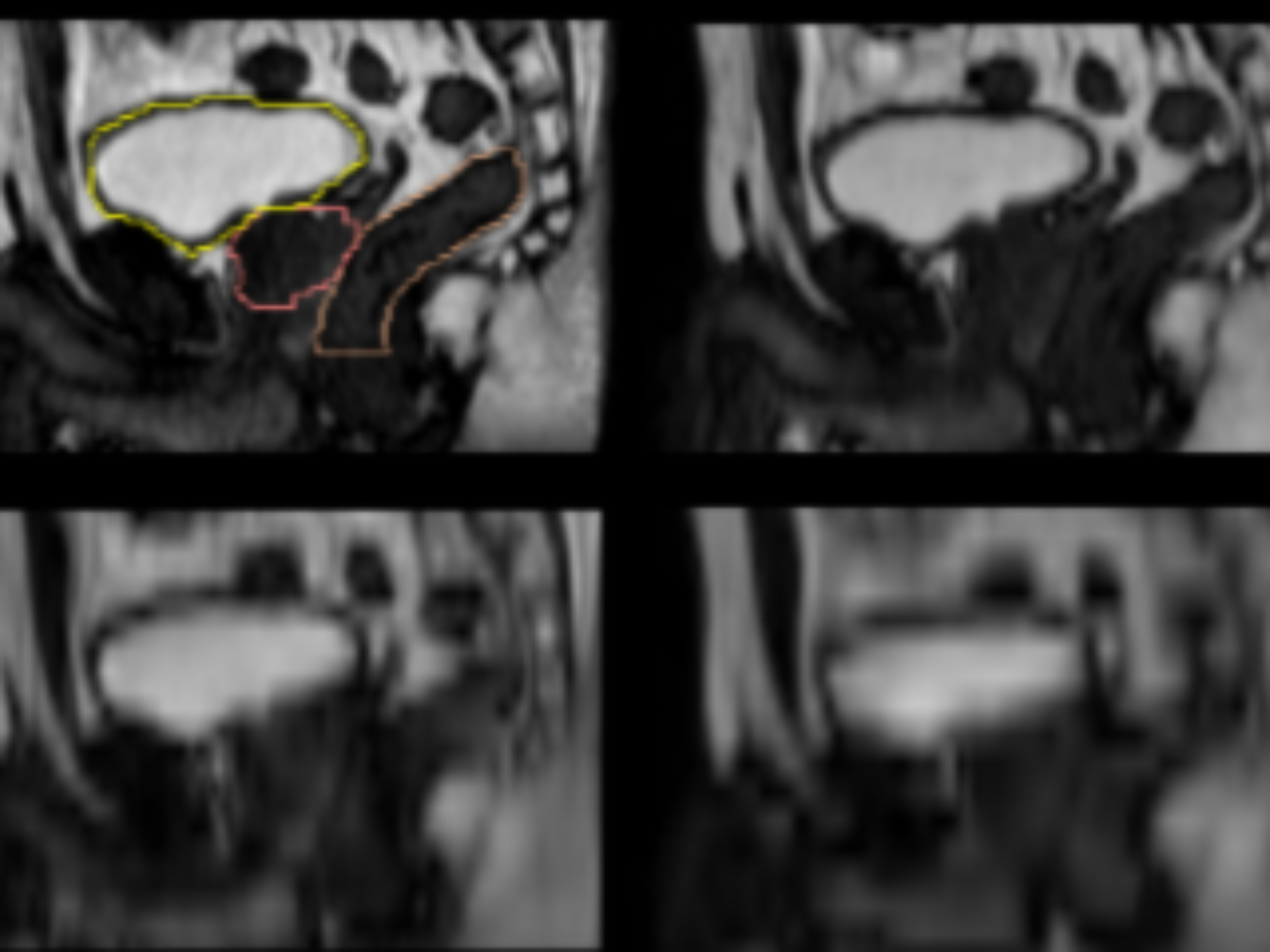 Figure 2. Example sagittal images of different resolution levels and delineations.