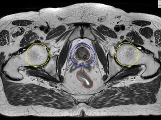 Figure 1. MRI volume with radiotherapy structures overlayed.