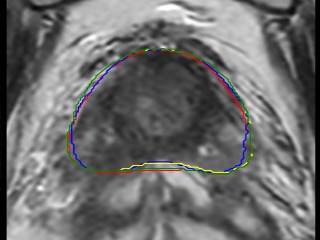 Figure 3. Left: T2w MRI with prostate delineation. Middle: Four oncologist individual prostate delineations on T2w MRI zoomed in, visualized in separate colors. Right: Deep Learning segmentation uncertainty map visualized in color.