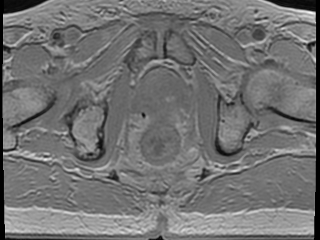 Figure 1. Pelvic transversal MEGRE image displaying an example of the first echo.