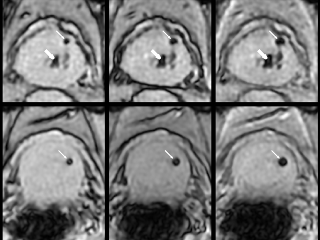 Figure 2. MEGRE images obtained using eight echo times, from 2.38 to 23.6 ms, for two different patients.