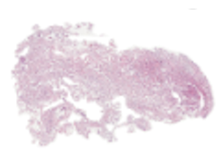 Figure 2. Overview of the H&E-stained meningioma histopathology of all sixteen samples.
