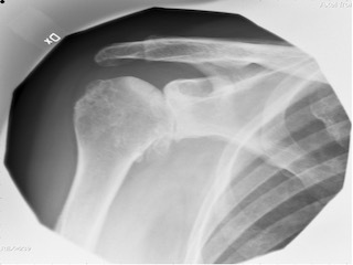 Figure 2. AP view of shoulder with OA changes, classified according to Samilson-Prieto.