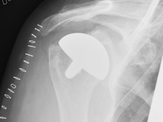 Figure 4. Images include inplants such as arthroplasties.